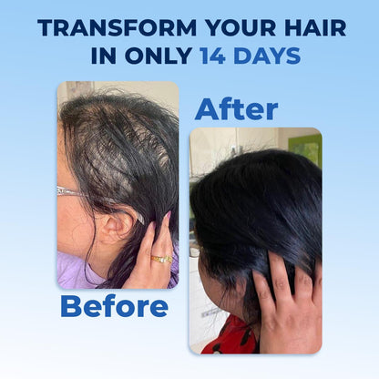 FEG-PLUS With Derma Roller Rosemary Beard & Hair Growth Serum, Rosemary, Minoxidil 5% Solution for Hair Growth Booster